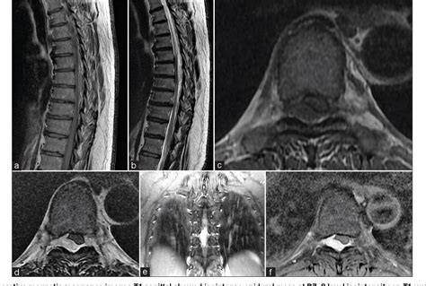 Pdf Dorsal Spinal Epidural Cavernous Angioma A Case Report