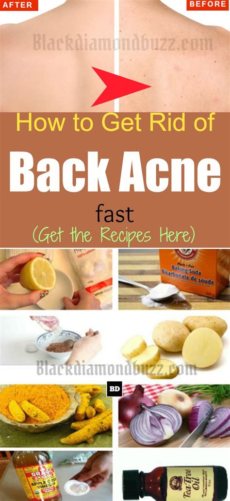 How To Get Rid Of Back Acne Fast 7 Best Home Remedies For Backne Blackdiamondbuzz