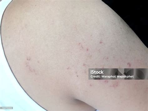 Ringworm Rash On Arm