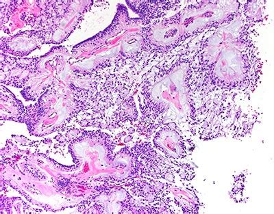 Pictures of Myxopapillary Ependymoma | Weill Cornell Brain and Spine Center