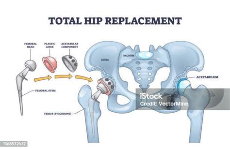 Total Hip Replacement Surgery With Acetabular Prosthesis Outline