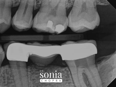 A Tooth Story Of Necrotic Pulp Diagnosis Sonia Chopra Dds