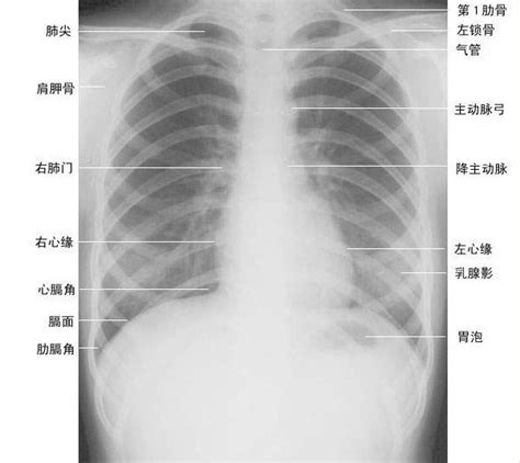 正常胸部影像解剖图 医学影像图医学图库