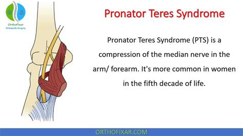 Pronator Teres Syndrome Artofit