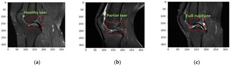 Anterior Cruciate Ligament Mri