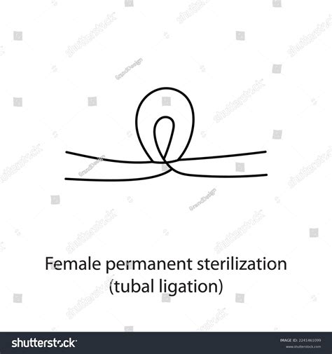 Female Permanent Sterilization Method Contraception Tubal Stock Vector