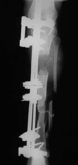 Surgical Treatment Of Osteomyelitis Musculoskeletal Key