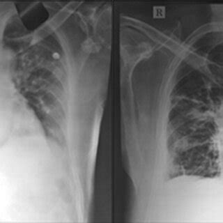 a X-ray of the lungs before treatment (Left Image) b X-ray of the lungs... | Download Scientific ...