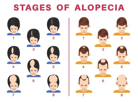 Conjunto De Ilustraciones De Etapas De Alopecia En Hombres Y Mujeres