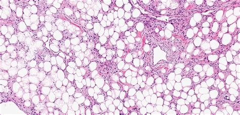 Pathology Outlines Solitary Fibrous Tumor