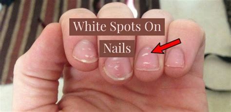 What Causes White Spots On My Toenails Design Talk