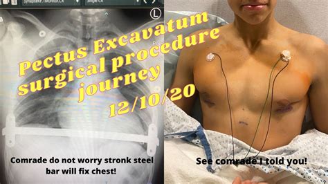 Operation Nuss Procedure Pectus Excavatum Surgery Journey Documentary Youtube