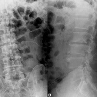 A B Postoperative A Anteroposterior And B Lateral Radiographs