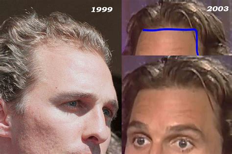 Matthew McConaughey Hair Loss Secrets Revealed!