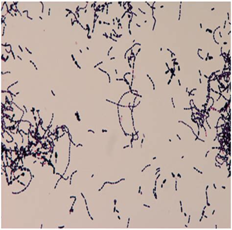 Streptococcus Bovis Prosthetic Valve Endocarditis Associated With