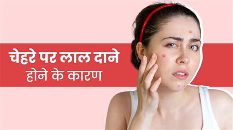 मौसम बदलने पर चेहरे पर हो जाते हैं लाल दाने जानें इसके 5 कारण Red Bumps On Face Causes During