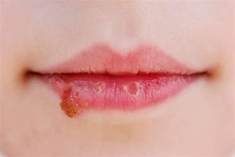 Herpes Labial O vírus que vai e volta Trindade Odontologia