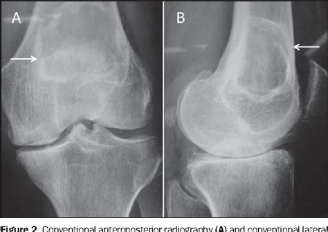 Figure 3 From Knee Bone Tumors Findings On Conventional Radiology