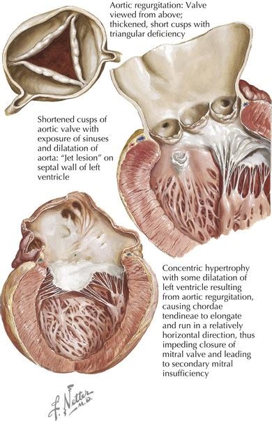 Aortic Regurgitation Thoracic Key