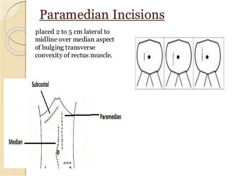 Abdominal Incisions