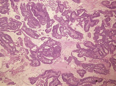 Photomicrography Of The Paratesticular Tumor Showing Complex Cribriform