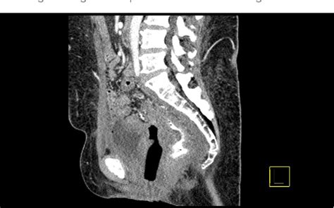 Figure 1 From Mdct Cystography Using Vaginal Tampon For Imaging Lower