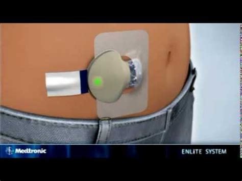 Medtronic Enlite Sensor Transmitter Diagram Of Parts Medtron