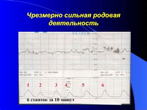 Как отображаются схватки на ктг фото