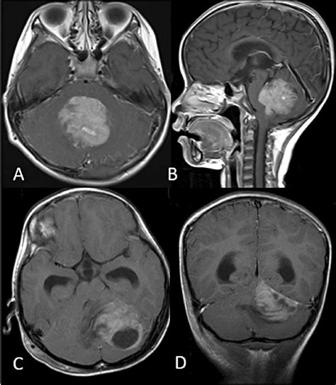 Axial A And Sagittal B T Weighted Gadolinium Enhanced Mri Showing