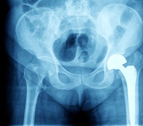 Outpatient Hip Replacement Cedar Orthopaedic Surgery Specialty Clinic