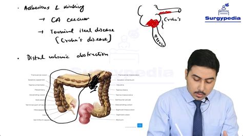 Appendicitis Pathophysiology Diagram