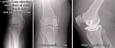 Knee Treatments Northampton Orthopaedics Surgery And Sports Injuries