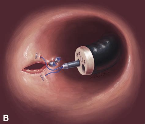 Endoscopic Colotomy Closure For Natural Orifice Transluminal Endoscopic