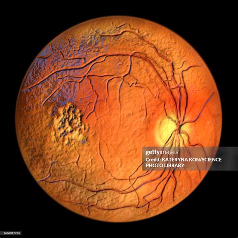 Best Vitelliform Macular Dystrophy Illustration High-Res Vector Graphic ...