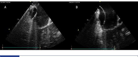 Routine Use Of Intracardiac Echocardiography For Atrial Flutter