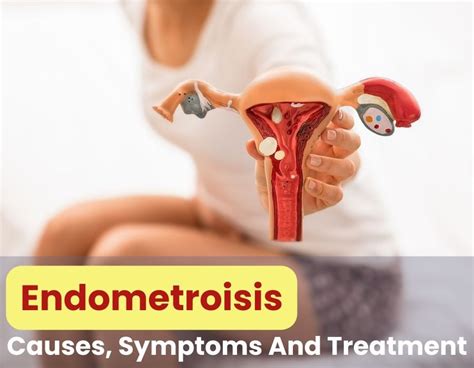 Understanding Endometriosis Causes Symptoms And Treatment Femcare