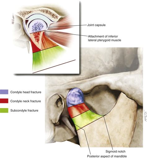 Mandibular Condyle Surgery