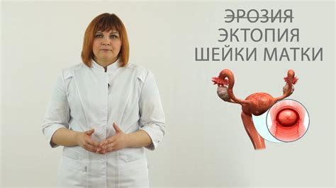 эрозия ( эктопия ) шейки матки - YouTube