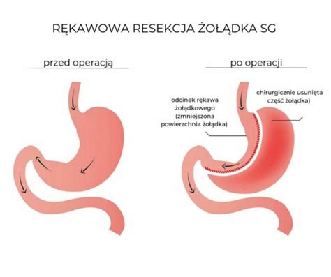 R Kawowa Resekcja O Dka Dermedik Krak W