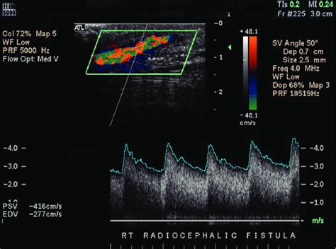 Normal Arterio Venous Fistula Demonstrating Marked Spectral Broadening