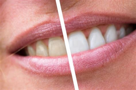 10 Facts About Teeth Whitening Everyone Should Know Whitney Ranch Dental