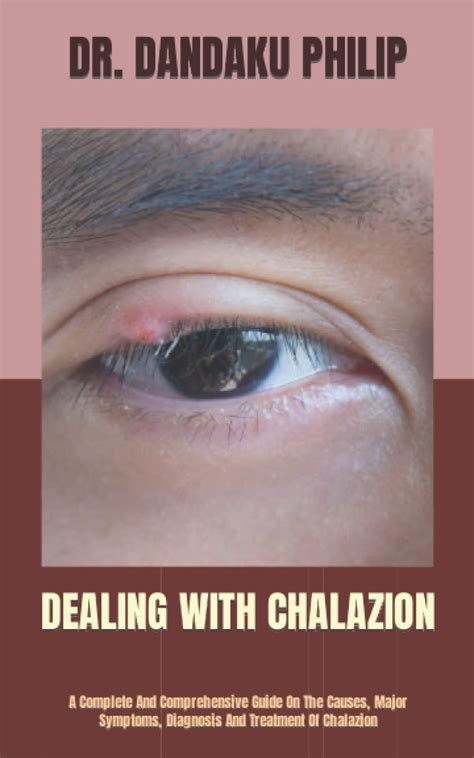 Dealing With Chalazion A Complete And Comprehensive Guide On The