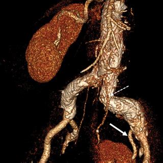 Three Month Postoperative Computed Tomography Angiography Depicting The