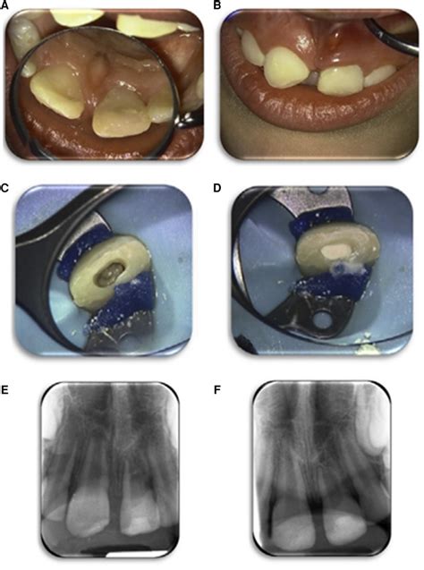 Frontiers Regenerative Endodontic Procedures In Immature Permanent