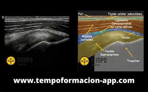 Tendón Supraespinoso Aprende a Valorarlo Ecografía Tempo Formación