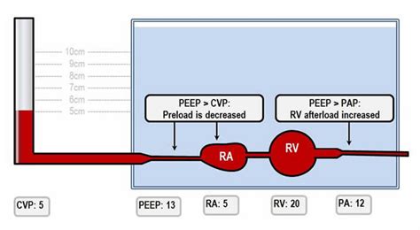 Effects of positive pressure ventilation on cardiovascular physiology ...