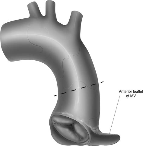 Technique For The Repair Of Truncus Arteriosus To Maintain Pulmonary