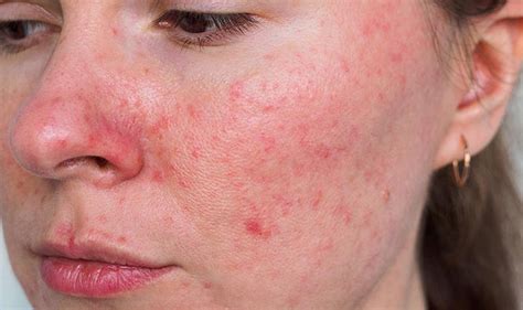 Apa Itu Rosacea Kenali Gejala Penyebab Dan Cara Mengobatinya