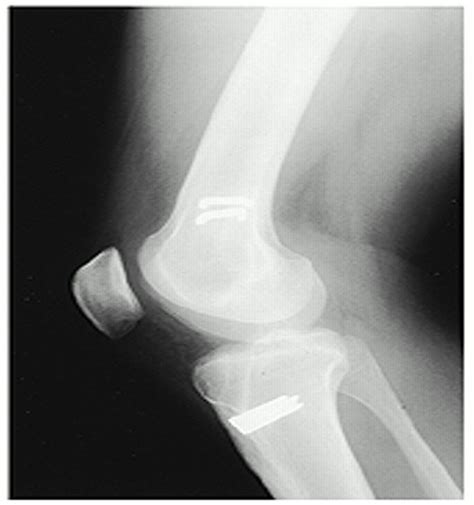 Arthroscopically Assisted Reconstruction Of The Anterior Cru Jbjs