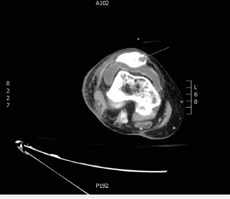 Osteomyelitis of the right knee A large right knee effusion with... | Download Scientific Diagram